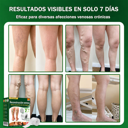 🇪🇸👨‍⚕️ DR.Fachmer® 💚 Parche de Microneedles Vein Ease (Para arañas vasculares, varices, hinchazón y piernas cansadas)