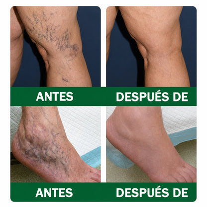 🇪🇸👨‍⚕️ DR.Fachmer® 💚 Parche de Microneedles Vein Ease (Para arañas vasculares, varices, hinchazón y piernas cansadas)
