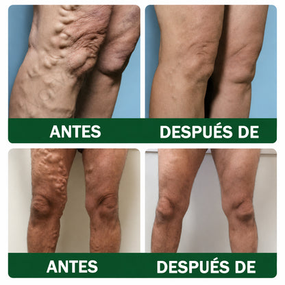 🇪🇸👨‍⚕️ DR.Fachmer® 💚 Parche de Microneedles Vein Ease (Para arañas vasculares, varices, hinchazón y piernas cansadas)