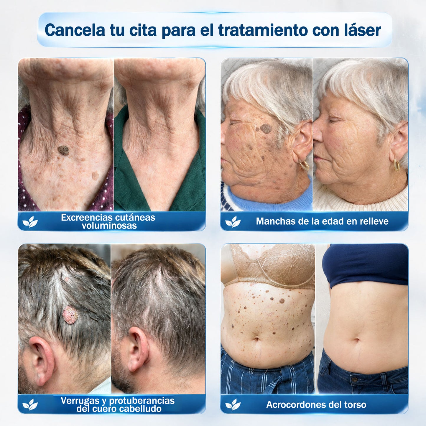 Rolimey® 🌿Borrador de Verrugas y Manchas en 7 Días (𝐀𝐩𝐥𝐢𝐜𝐚𝐝𝐨𝐫 𝐫𝐨𝐥𝐥-𝐨𝐧: 𝐬𝐢𝐧 𝐝𝐨𝐥𝐨𝐫 𝐧𝐢 𝐜𝐢𝐜𝐚𝐭𝐫𝐢𝐜𝐞𝐬)