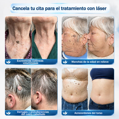 Rolimey® 🌿Borrador de Verrugas y Manchas en 7 Días (𝐀𝐩𝐥𝐢𝐜𝐚𝐝𝐨𝐫 𝐫𝐨𝐥𝐥-𝐨𝐧: 𝐬𝐢𝐧 𝐝𝐨𝐥𝐨𝐫 𝐧𝐢 𝐜𝐢𝐜𝐚𝐭𝐫𝐢𝐜𝐞𝐬)