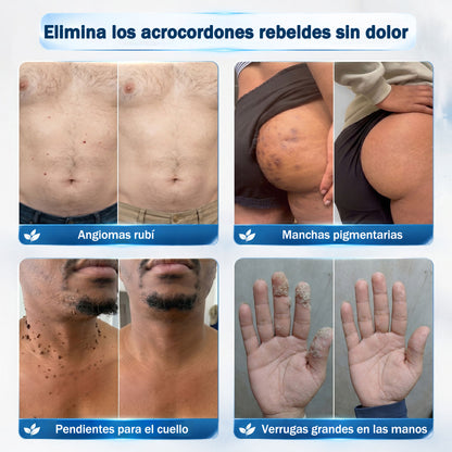 Rolimey® 🌿Borrador de Verrugas y Manchas en 7 Días (𝐀𝐩𝐥𝐢𝐜𝐚𝐝𝐨𝐫 𝐫𝐨𝐥𝐥-𝐨𝐧: 𝐬𝐢𝐧 𝐝𝐨𝐥𝐨𝐫 𝐧𝐢 𝐜𝐢𝐜𝐚𝐭𝐫𝐢𝐜𝐞𝐬)
