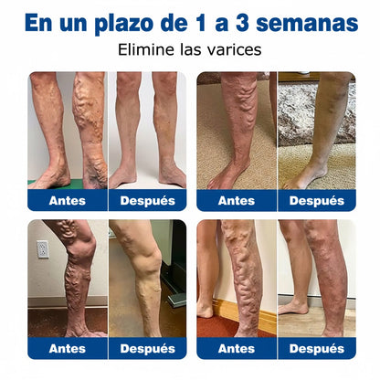 🇪🇸🤍✅Parche de microagujas GFOUK® VeinEase para el cuidado de las venas⚡Alivio instantáneo, resultados a largo plazo