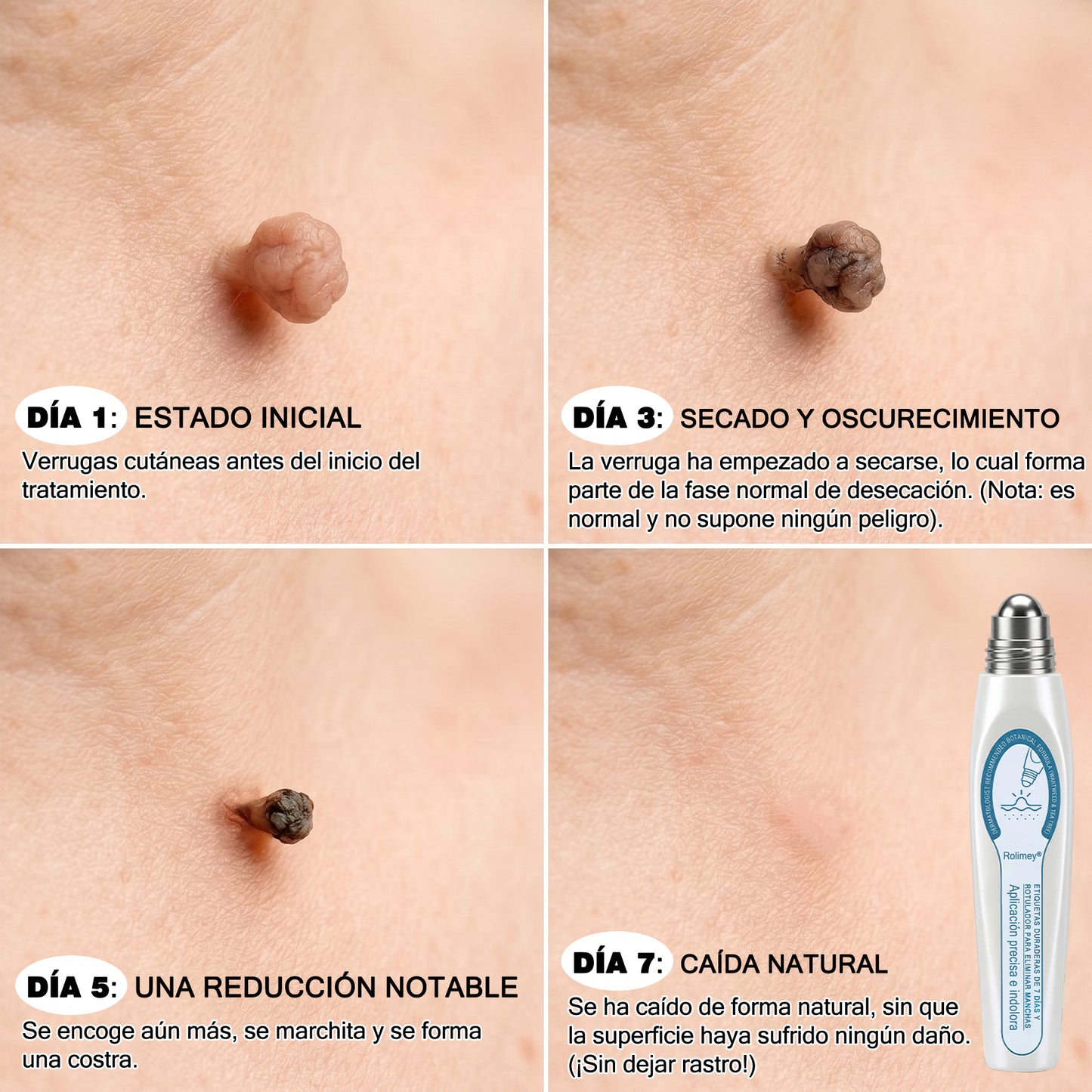 Rolimey® 🌿Borrador de Verrugas y Manchas en 7 Días (𝐀𝐩𝐥𝐢𝐜𝐚𝐝𝐨𝐫 𝐫𝐨𝐥𝐥-𝐨𝐧: 𝐬𝐢𝐧 𝐝𝐨𝐥𝐨𝐫 𝐧𝐢 𝐜𝐢𝐜𝐚𝐭𝐫𝐢𝐜𝐞𝐬)