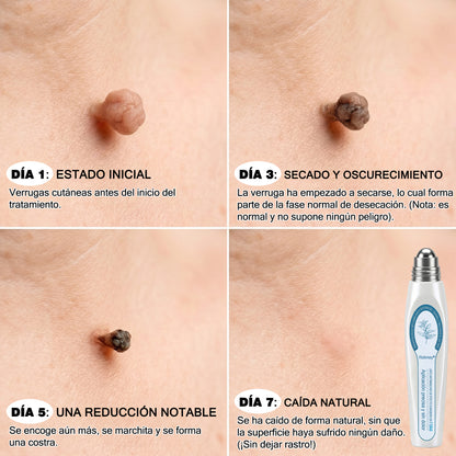 Rolimey® Borrador de marcas y manchas en 7 días (Roll-on sin dolor y sin cicatrices)✅ Apto para: acrocordones, manchas, lunares, verrugas, ampollas, eccema, caspa, queratosis, acné, crecimientos cutáneos, cicatrices, marcas de nacimiento👩‍⚕️